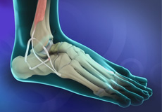Ankle Ligament Stabilisation