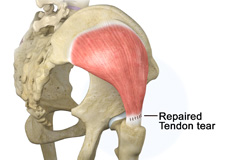 Gluteal Tendon Surgery