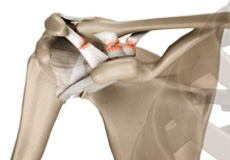 Acromioclavicular Joint (AC joint) Dislocation