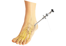 Ankle Arthroscopy