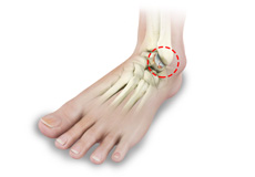 Ankle Injury