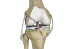 Arthroscopic ACL reconstruction and multi ligament surgery