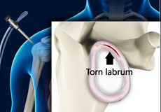 Arthroscopic shoulder stabilisation