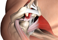 Arthroscopic subacromial decompression