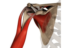 Meniscal Tears