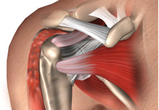 Biceps tenotomy with/without tenodesis