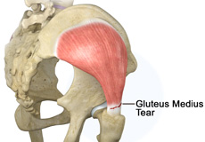 Gluteus Medius Tear