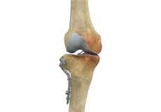 High Tibial Osteotomy