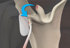 Open (Laterjet) shoulder stabilisation