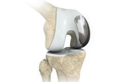 Partial knee replacement