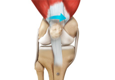 Patellofemoral Stabilisation and Realignment Surgery