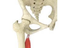 Proximal Hamstring Avulsion