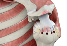 Rotator Cuff Repair