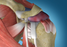 Shoulder Impingement