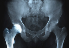 Transient Osteoporosis of the Hip